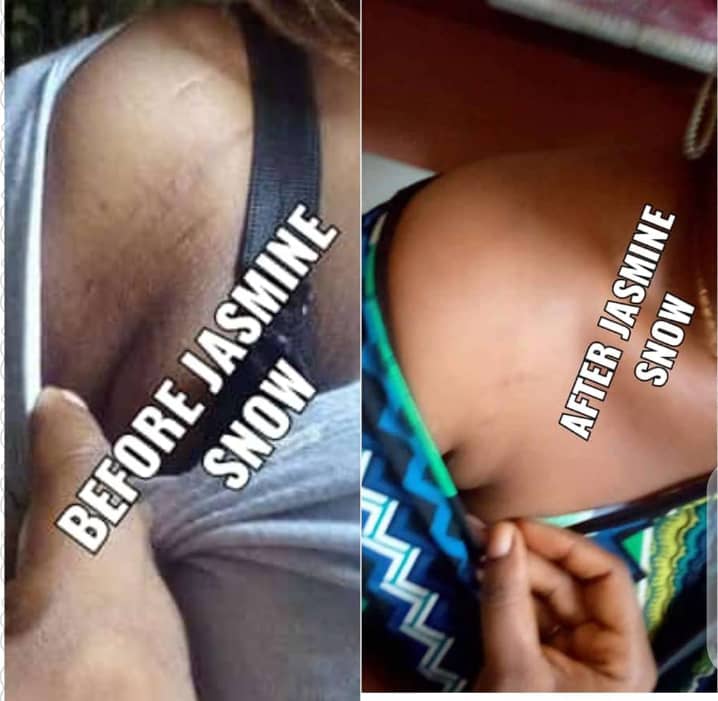 Stretch Marks Removal